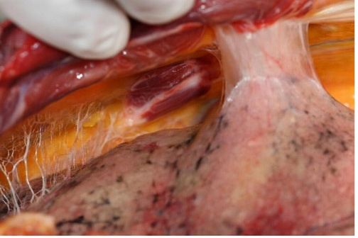 The Fascial network penetrates every muscle, surrounding eac