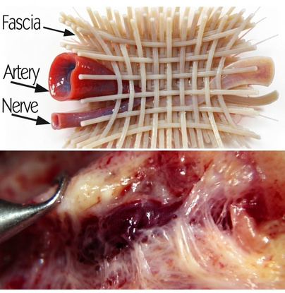 Fascia gripping a nerve and artery — the mechanical source of chronic pain signals